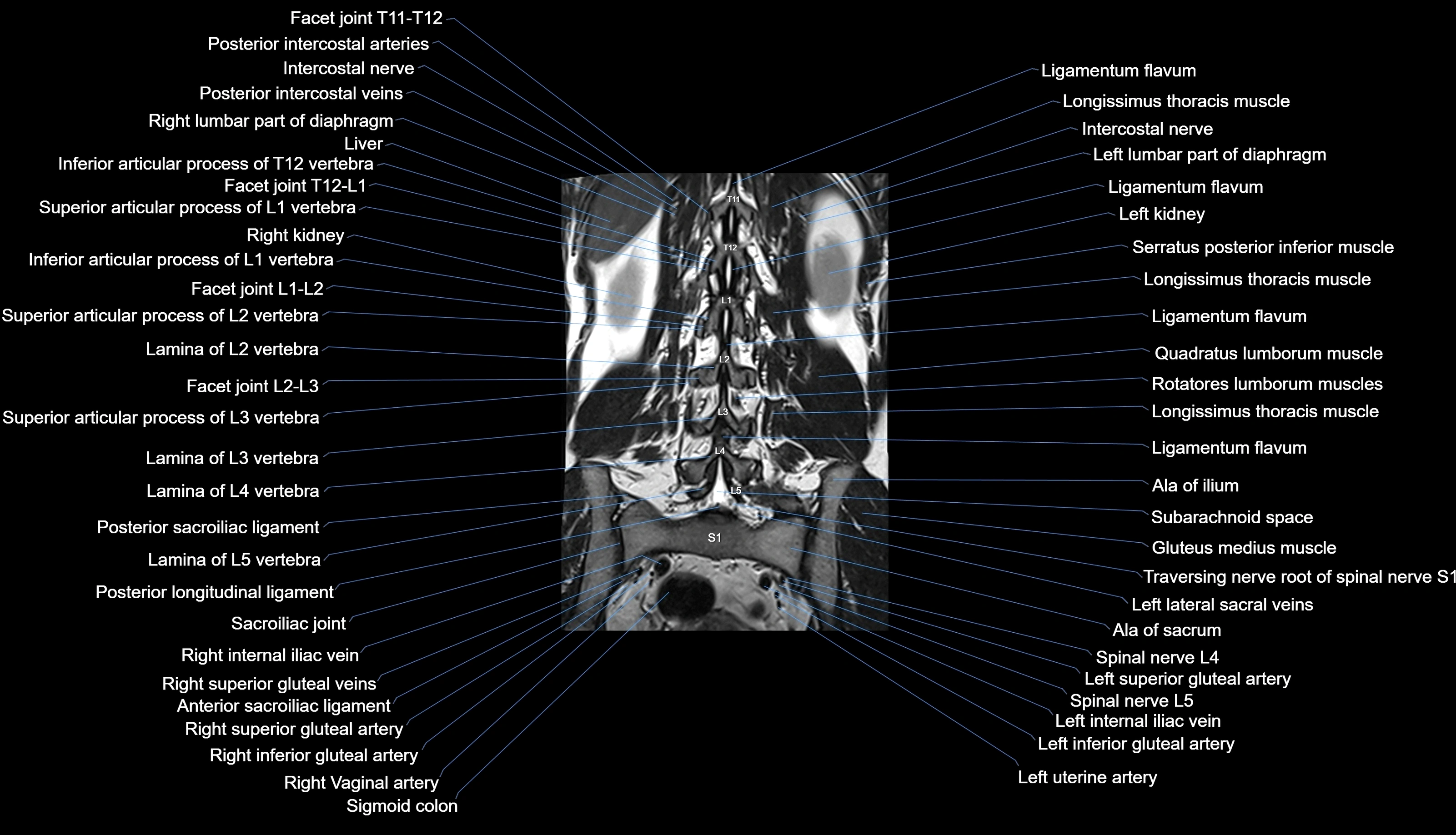 MRI lumbar spine labelled coronal cross sectional anatomy 3T radiology-img-00001-00023.webp